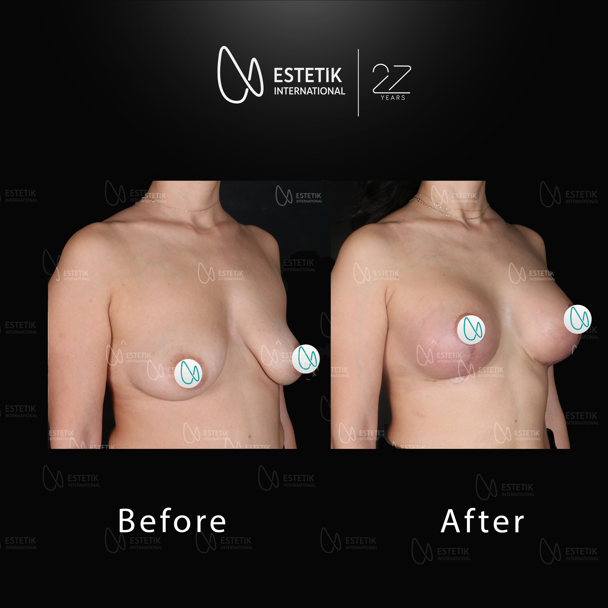 Breast Augmentation 4.jpg