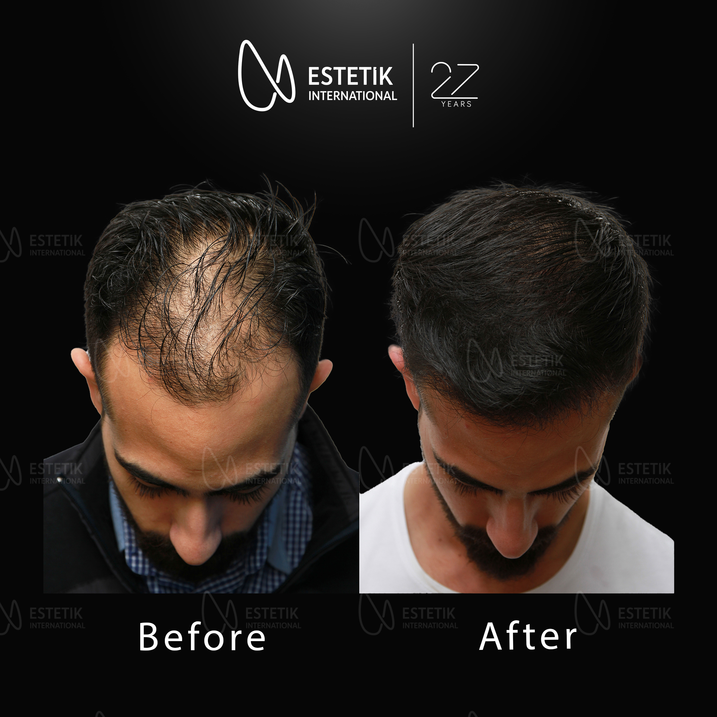 Hair Transplant 145.jpg