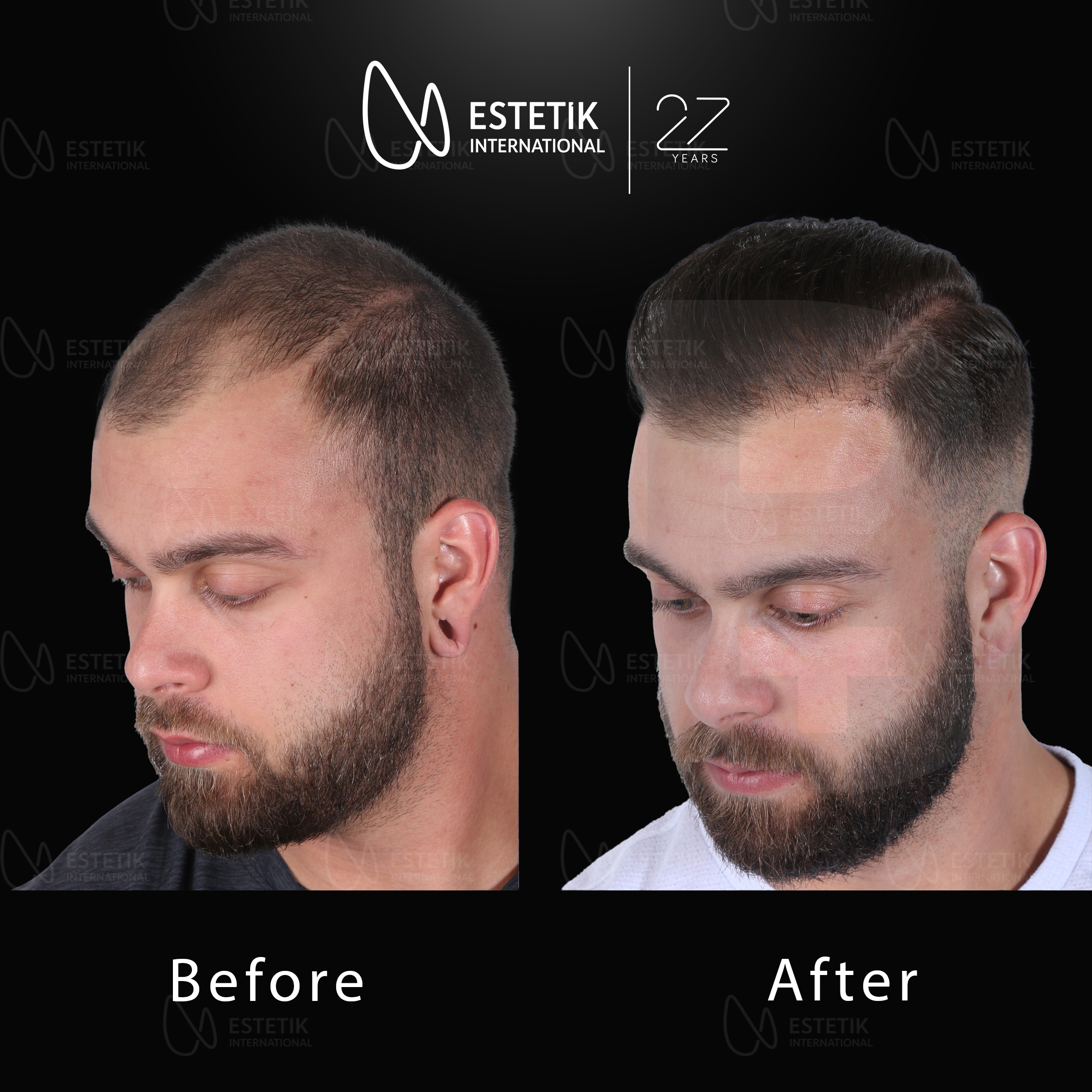 Hair Transplant 19.jpg