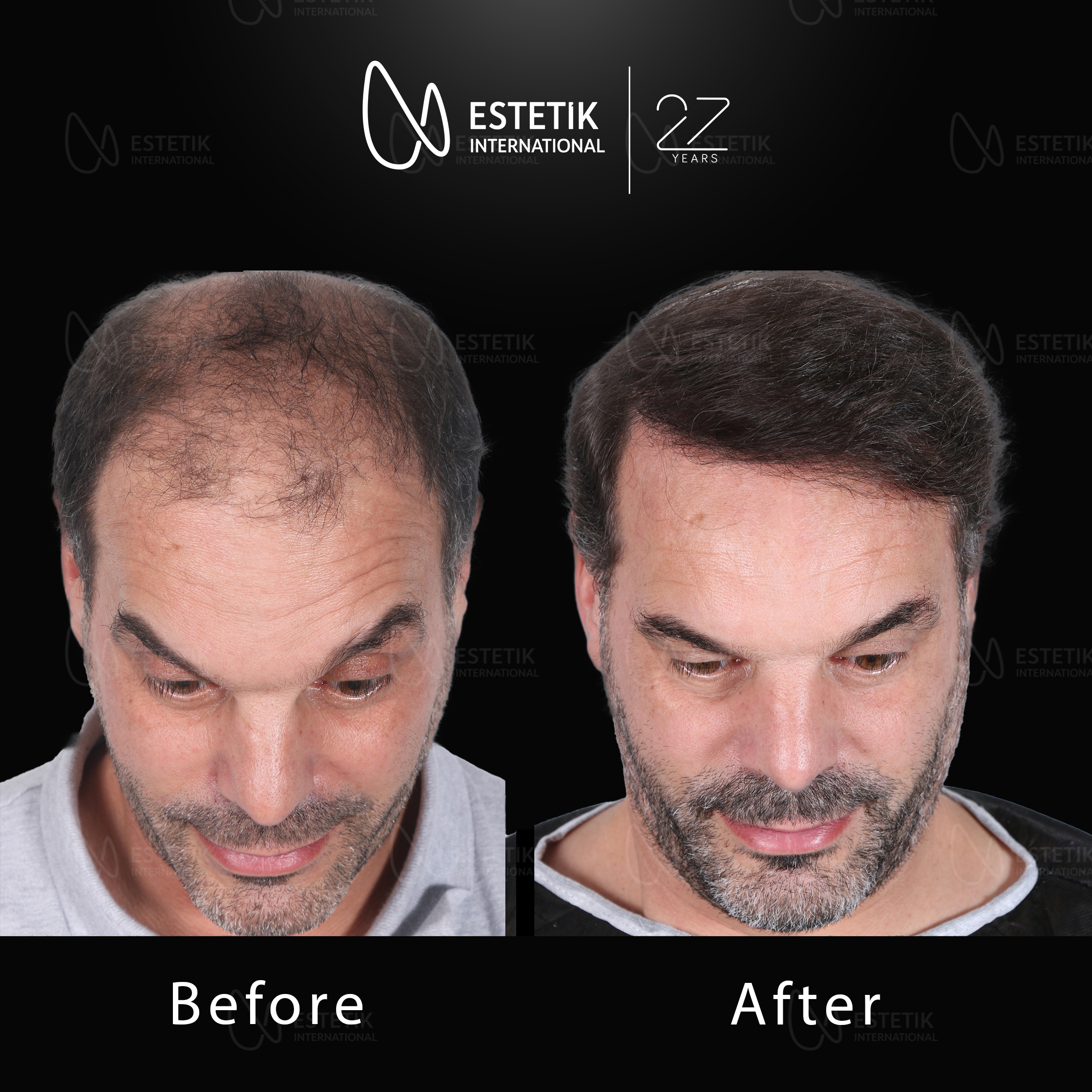 Hair Transplant 22.jpg