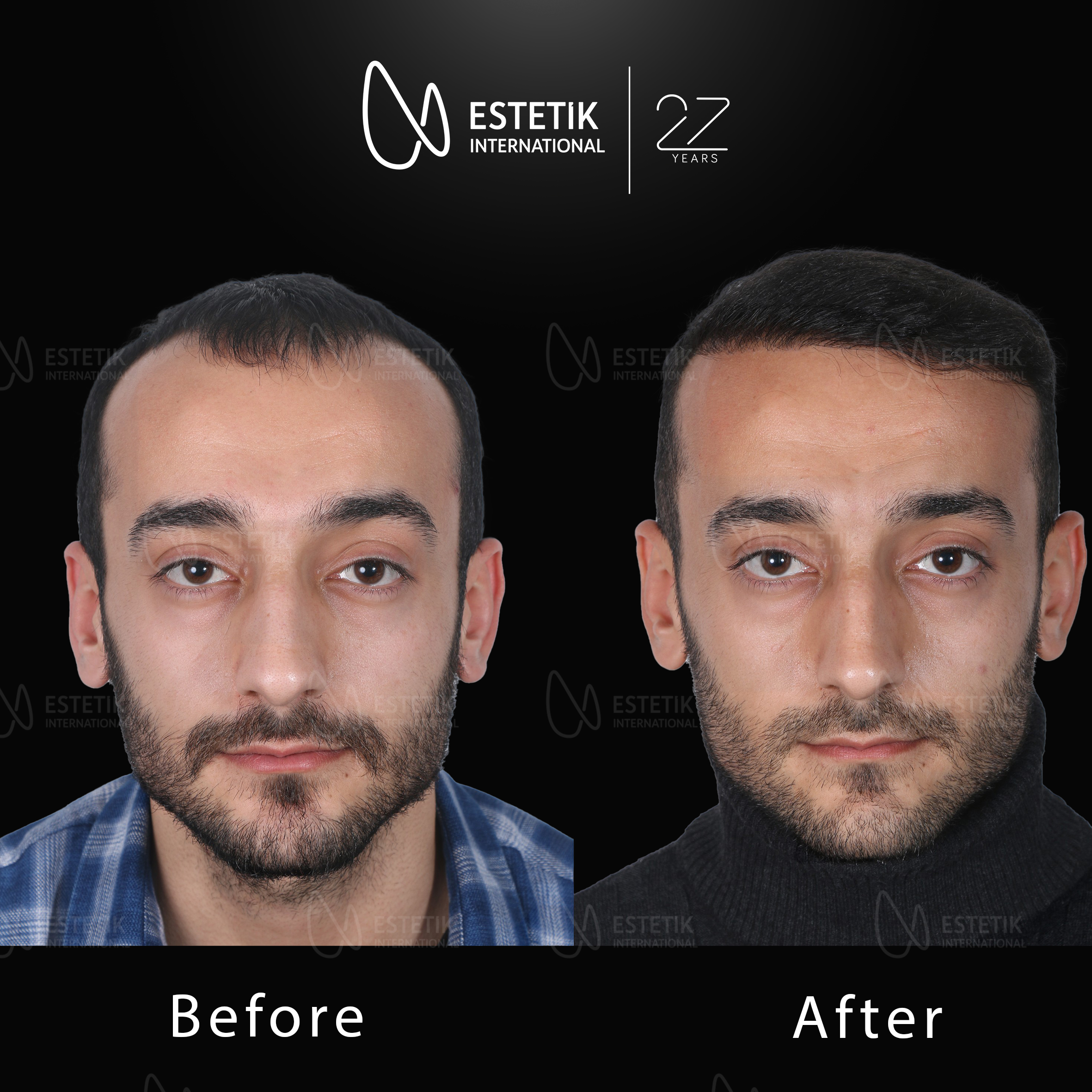 Hair Transplant 50.jpg
