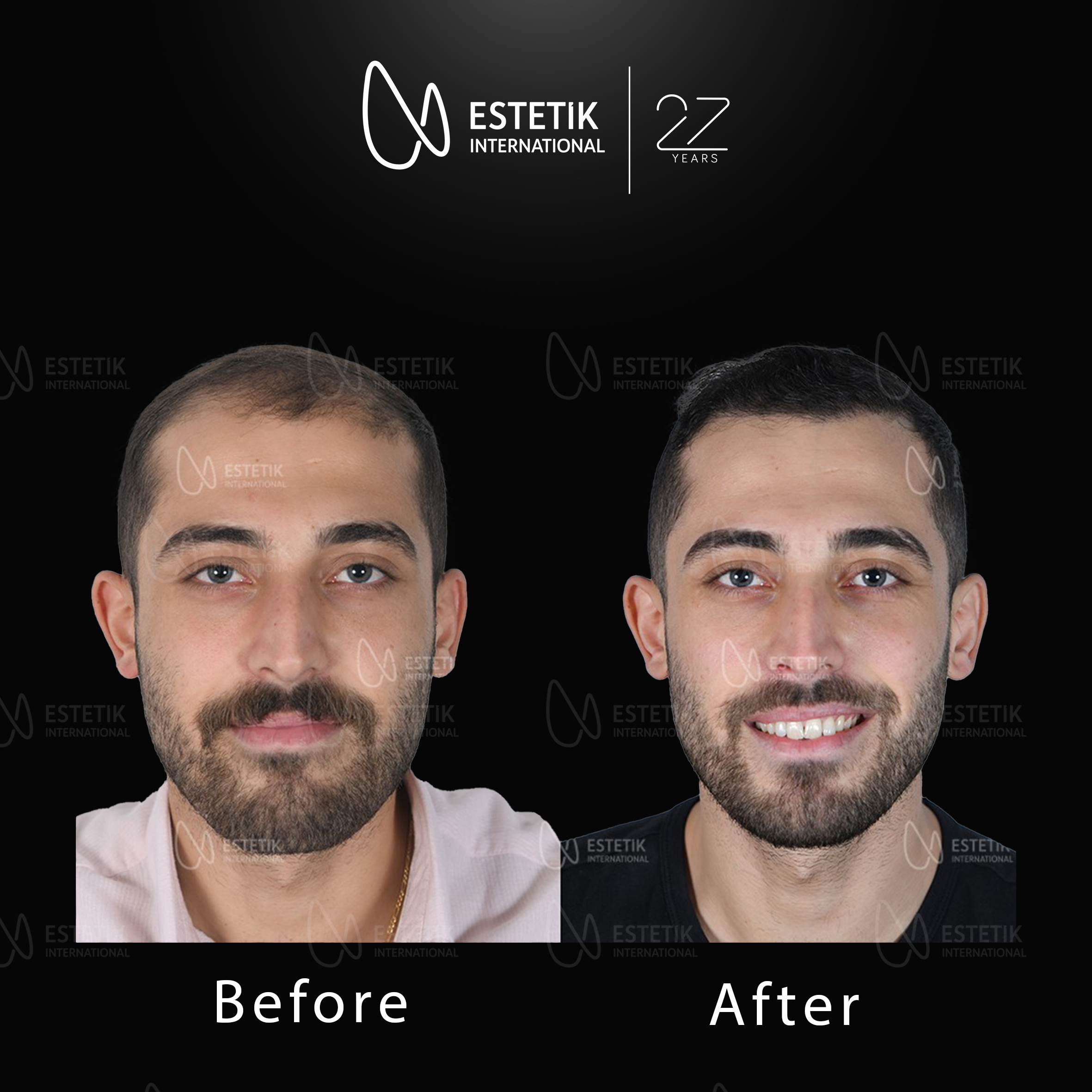 Hair Transplant 67.jpg