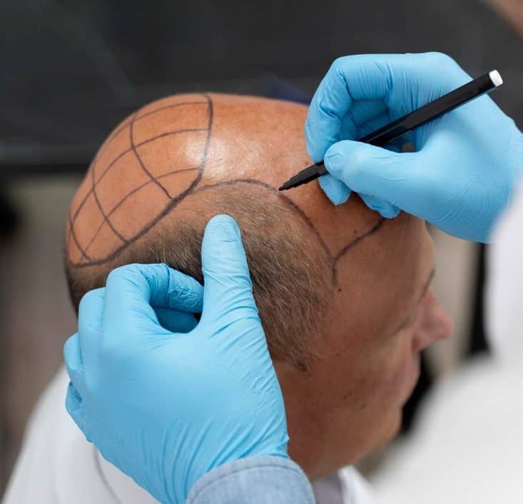 Hair Transplant Turkey price 1