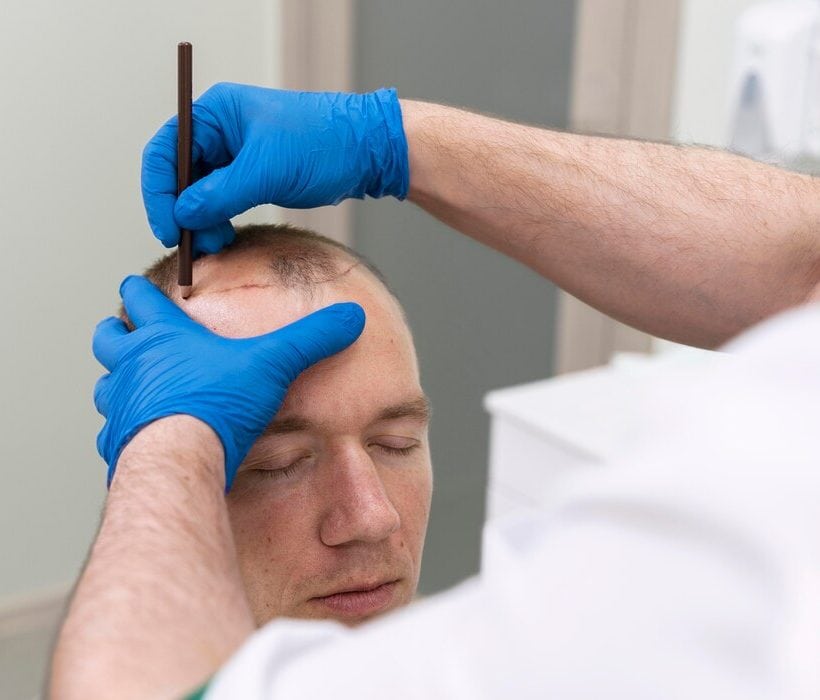 hair transplant turkey cost