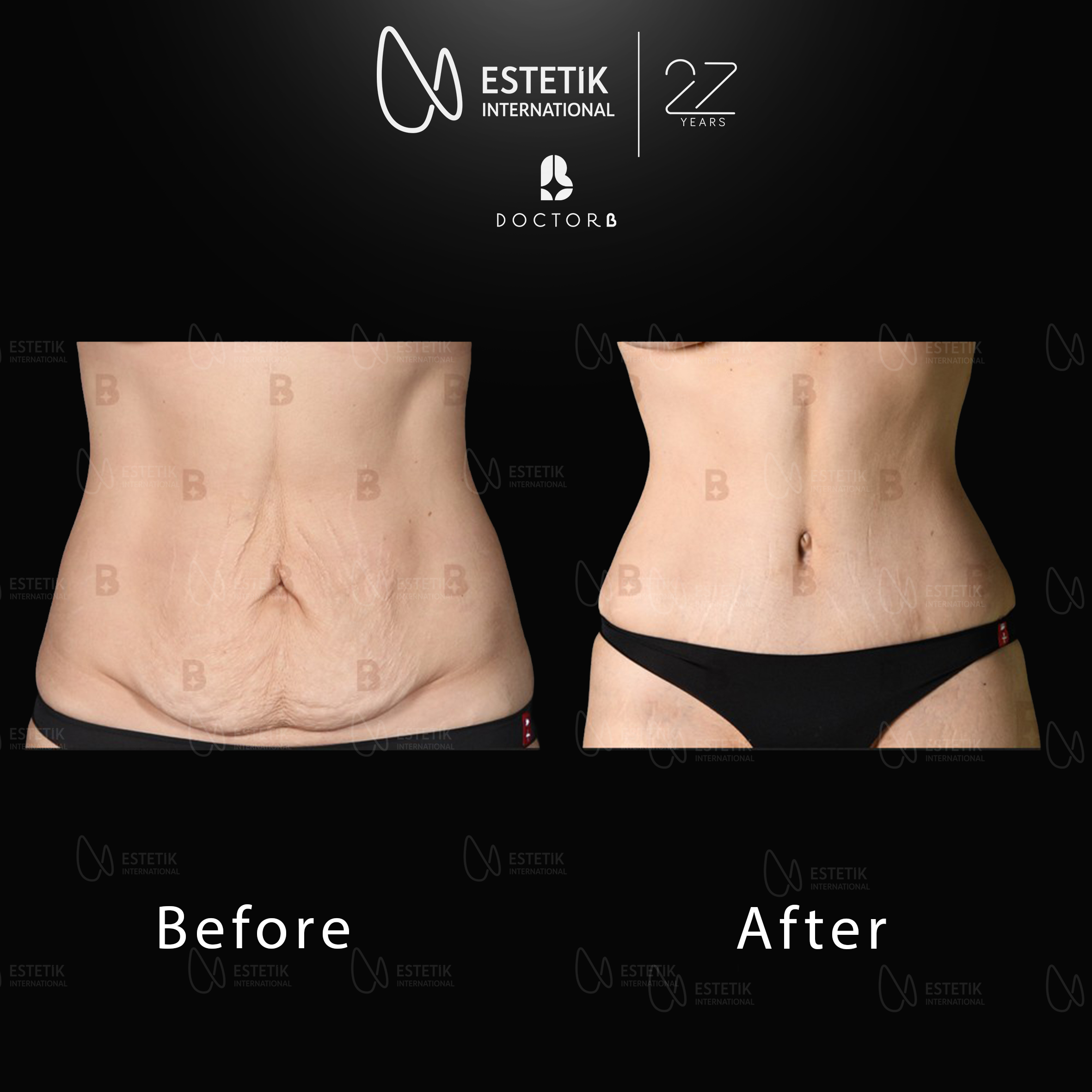 tummy tuck yeni 1.jpg
