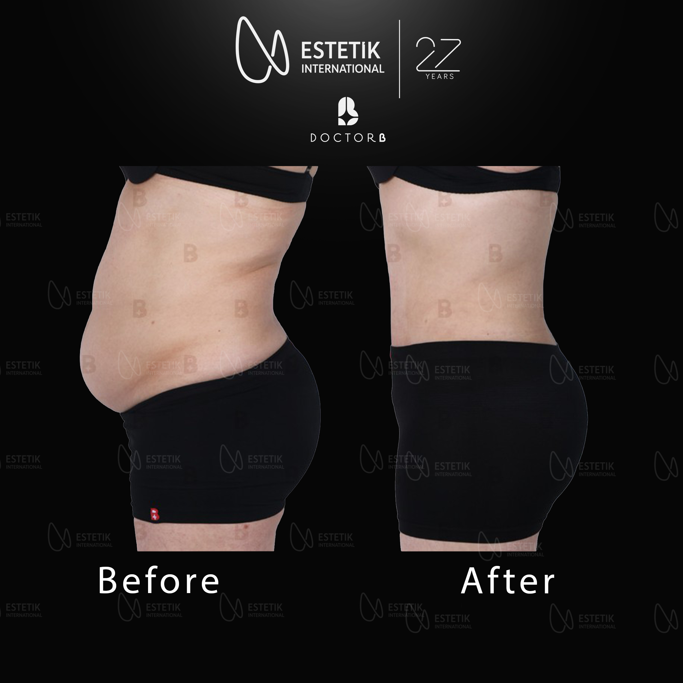 tummy tuck yeni 2.jpg